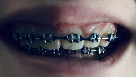 Braces have become a staple for growing up, whether you have them or not, generations have embraced the metal bars. 